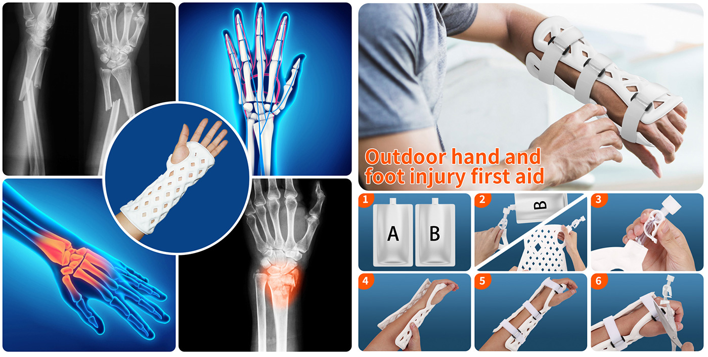 Medical-External-Fixation-Device-(Hand)-9