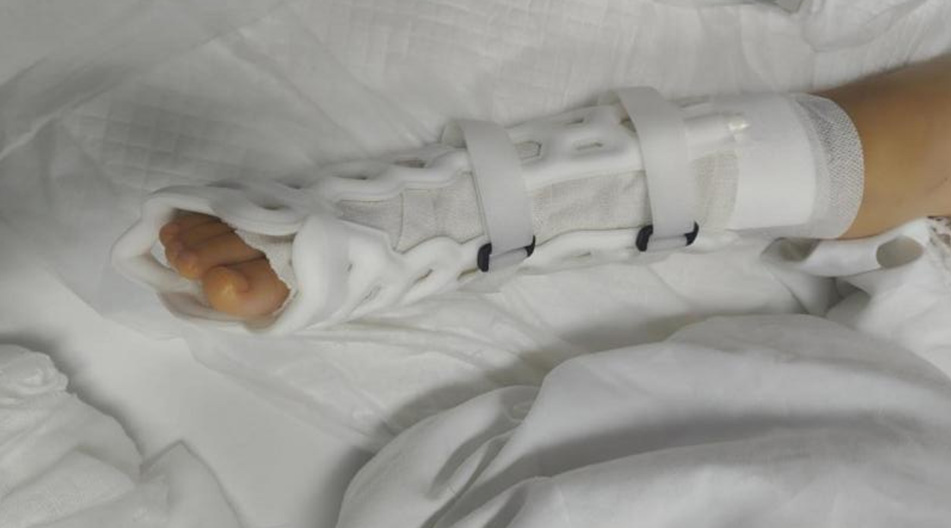 Clinical Application Cases of Orthopedic Products