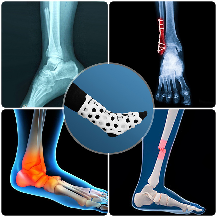 Medical-External-Fixation-Device-Foot-108-6